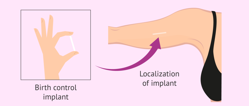 female contraceptives